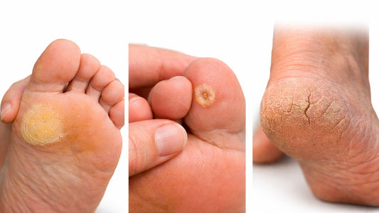 Calluses, Corns, and Cracked Heels: Causes, Treatments, and Whether Foot Masks and Patches Actually Help - Maskory